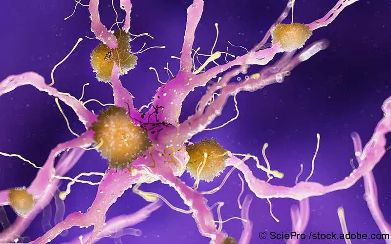 Amyloidablagerung Alzheimer