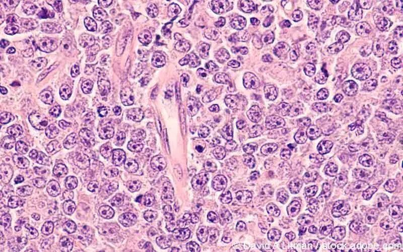 DLBCL