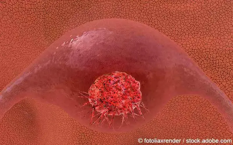 Gebaermutterhalskrebs