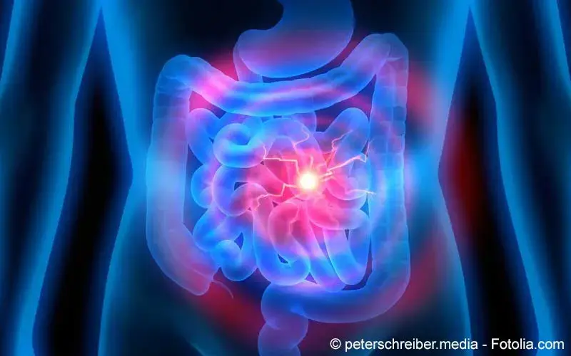 Darm Entzündung Krebs