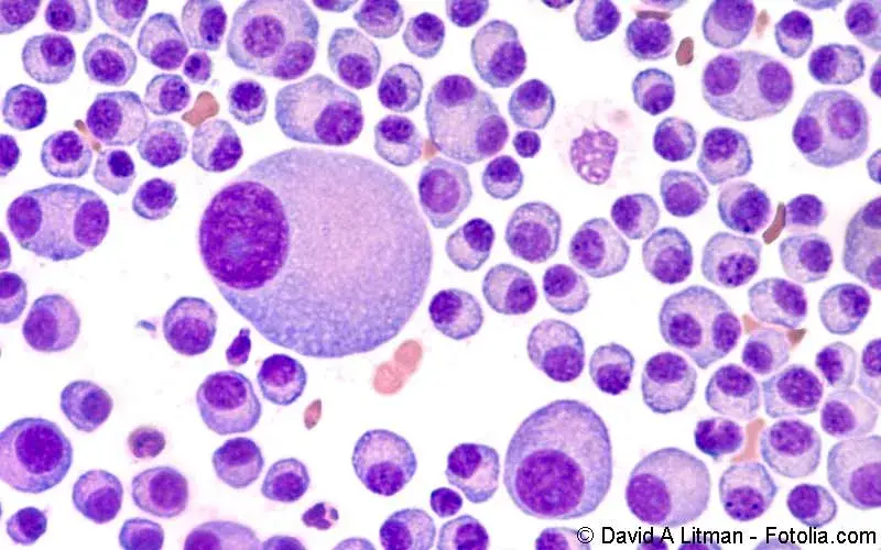 Multiples Myelom