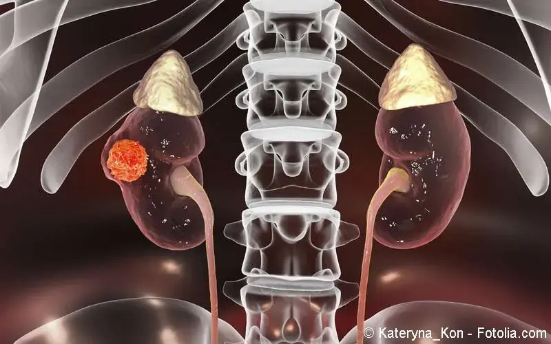 Nierenkrebs