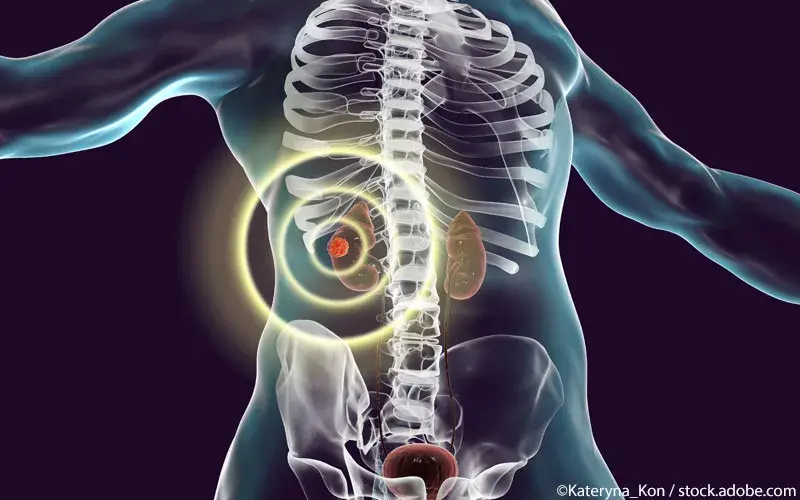 Nierenzellkarzinom-Torso