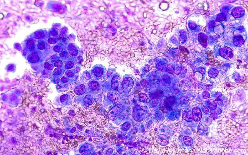 NSCLC