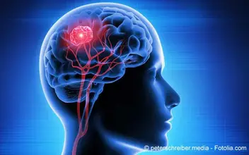 Gehirntumor Gehirntumor