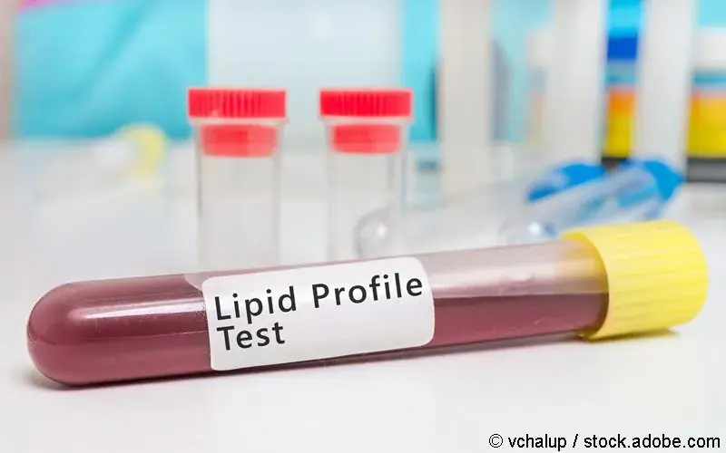 Lipid Profile Test