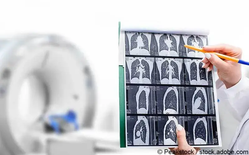 Lungenkrebs Screening