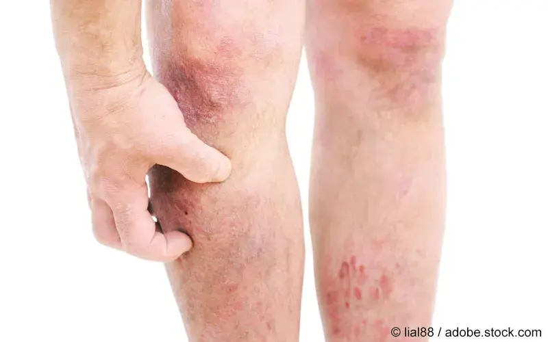 Atopische Dermatitis