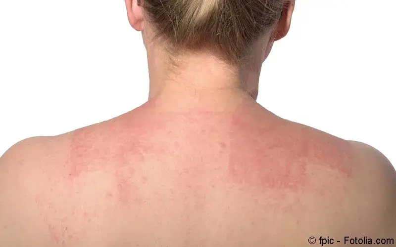Ausschlag Ruecken