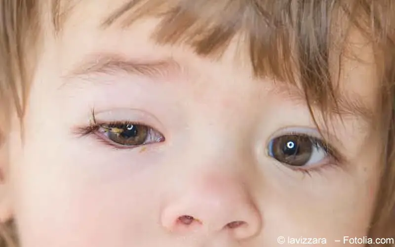 Bindehautentzündung Kind
