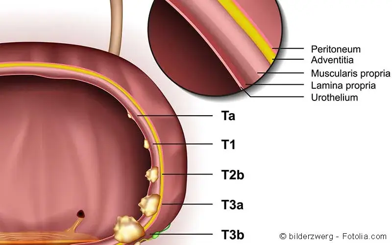 Harnblasenkarzinom Symptome Diagnostik Therapie Gelbe Liste