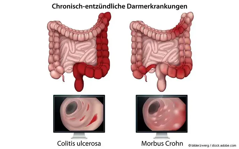 chronisch entzuendliche Darmerkrankungen