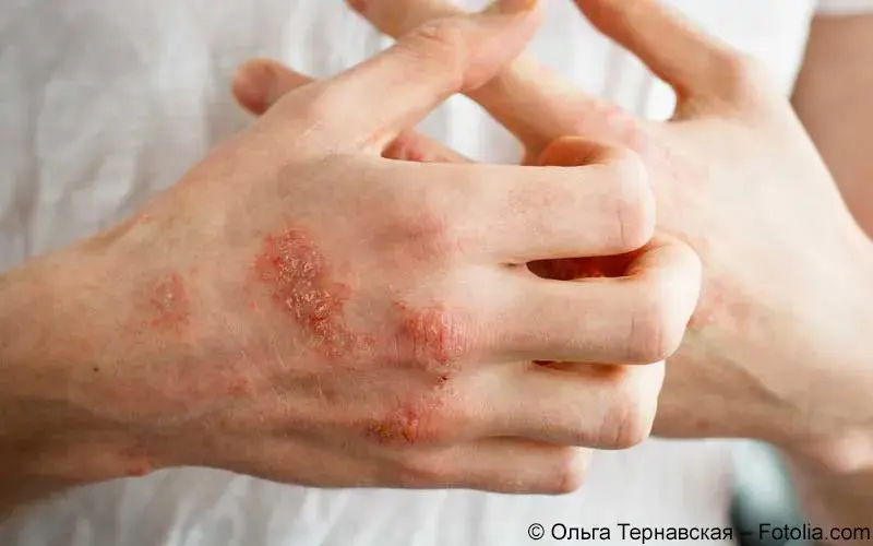 Ekzem Hand