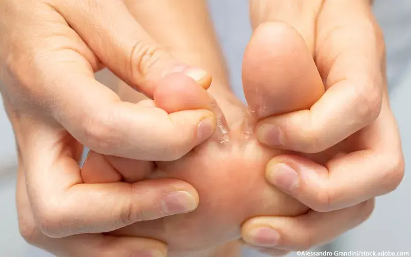 Fußpilz Tinea pedis