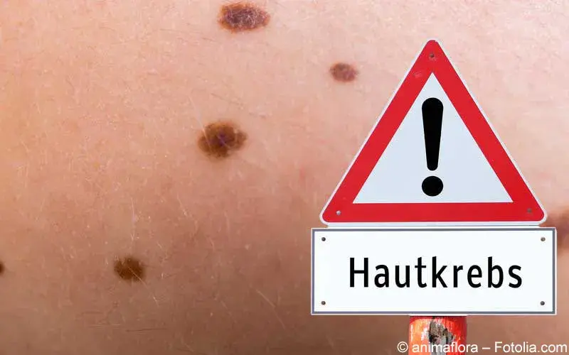 Hautkrebs