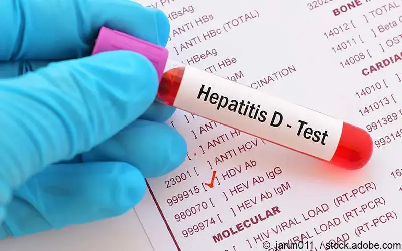 Hepatitis D