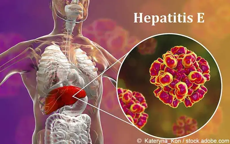Hepatitis E