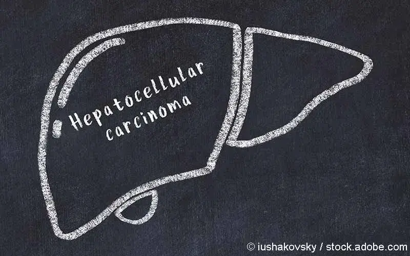 Hepatozellulaeres Karzinom