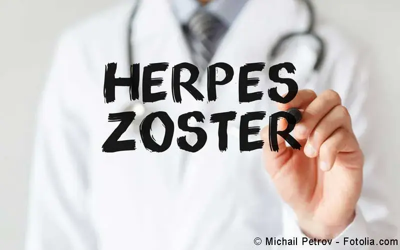 Herpes zoster