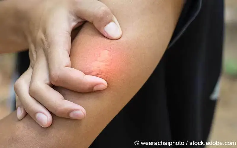 Insektenstich-allergisch