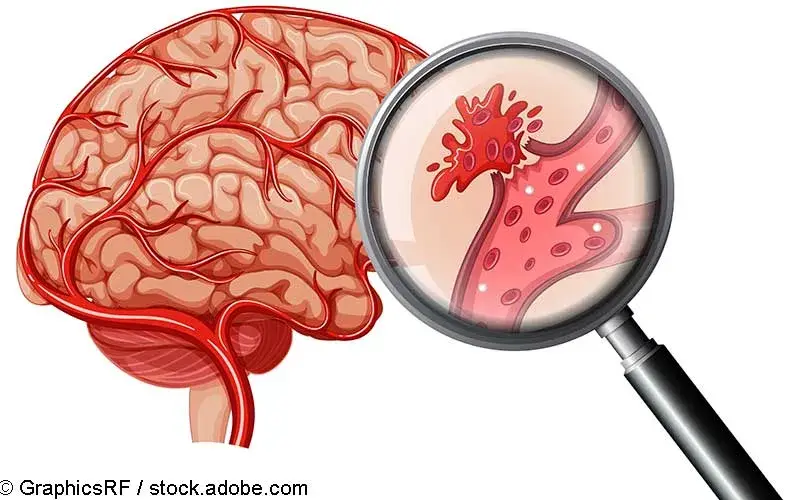 Intrakranielle Blutung