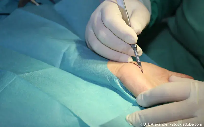 Karpaltunnel Syndrom