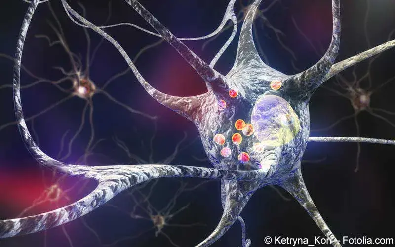 Lewy-Bodies-Parkinson