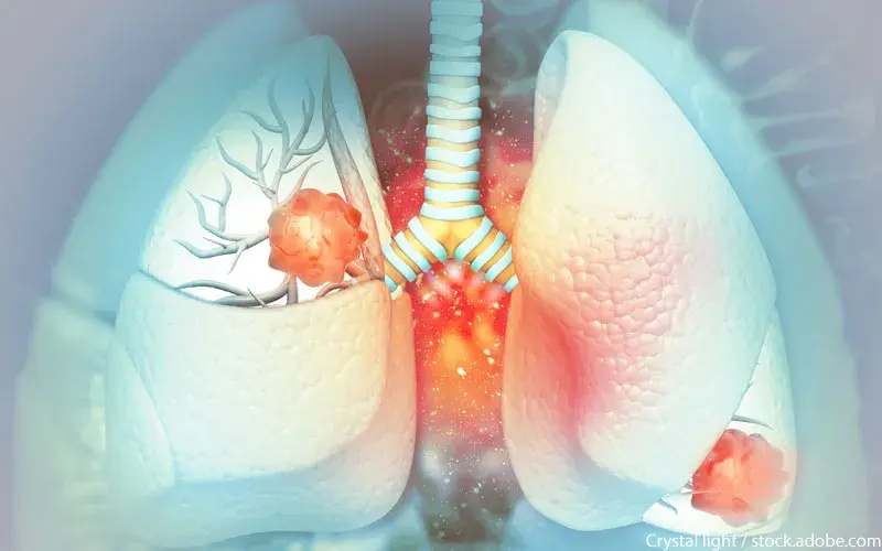 Lungenkrebs, Bronchialkarzinom