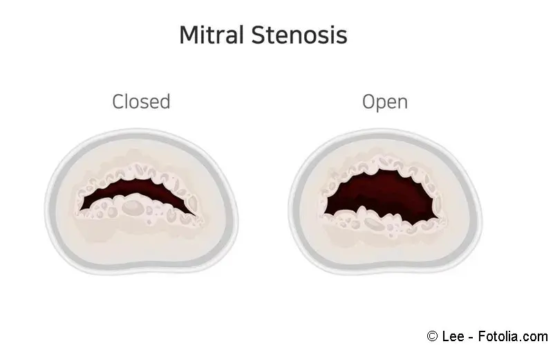 Mitralstenose