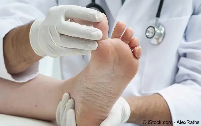 Nagelpilz Behandlung
