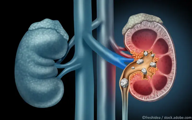 Nierensteine