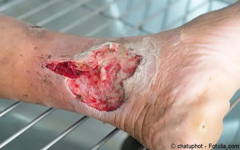 Offene Wunde Bein