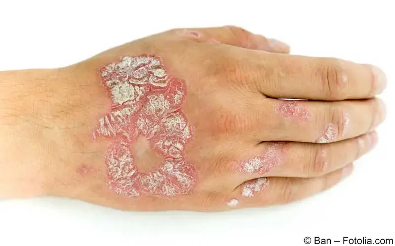 Plaque-Psoriasis