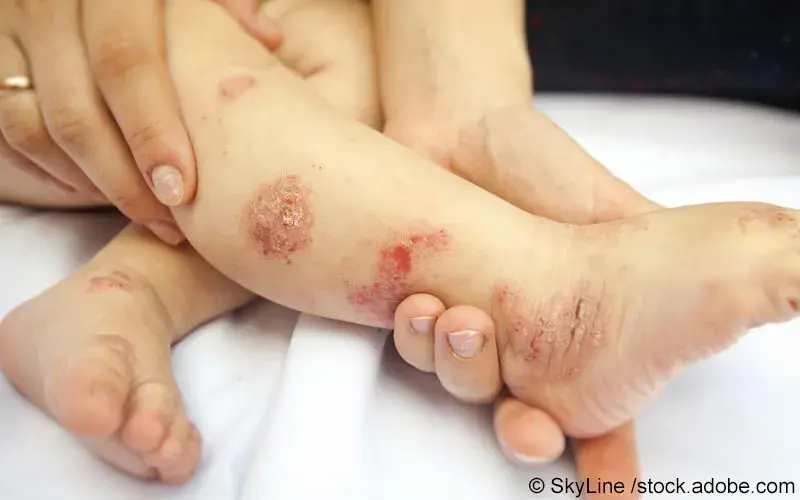 Psoriasis Kind