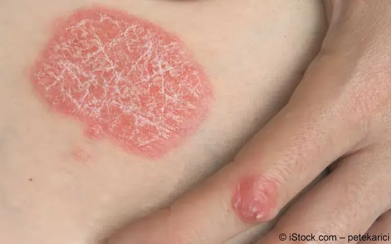 Psoriasis