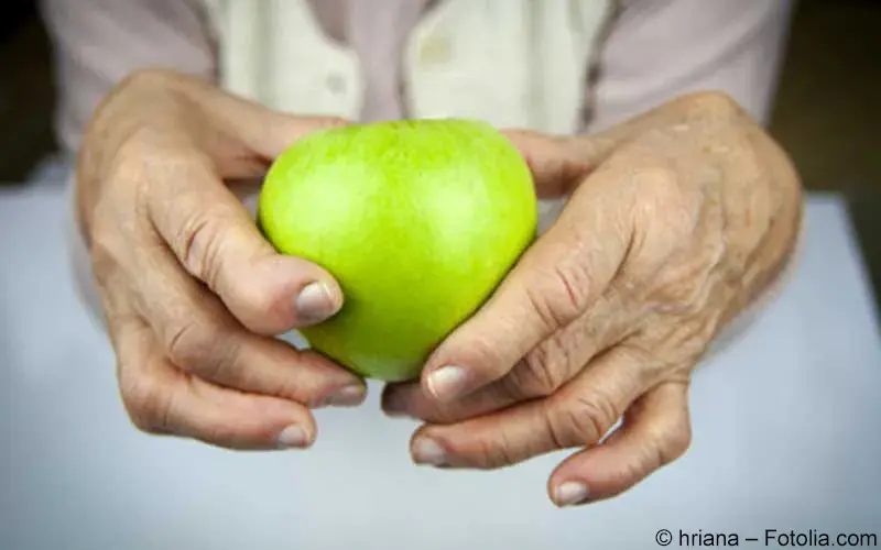 Rheumatische Hand