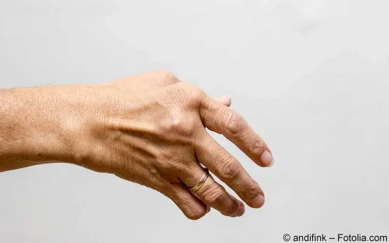 Rheuma an der Hand