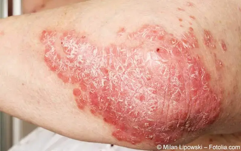 Schuppenflechte am Ellbogen