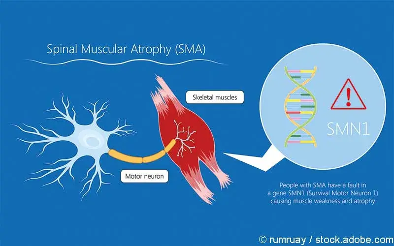 Spinale Muskelatrophie