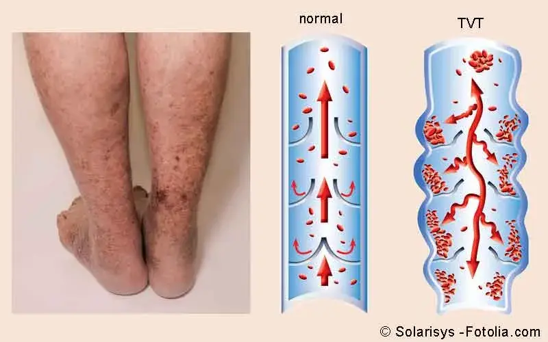 Tiefe Venenthrombose (TVT)