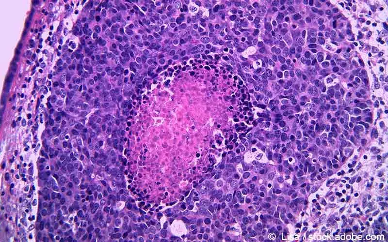 Urothelkarzinom