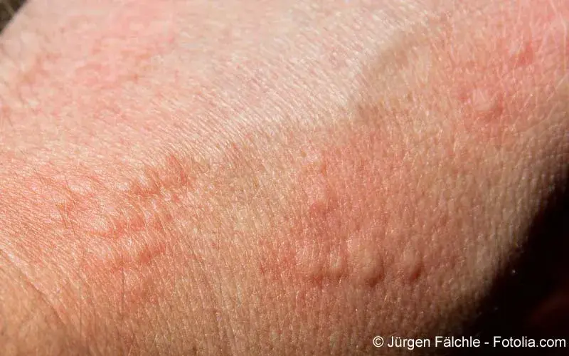Urtikaria Haut