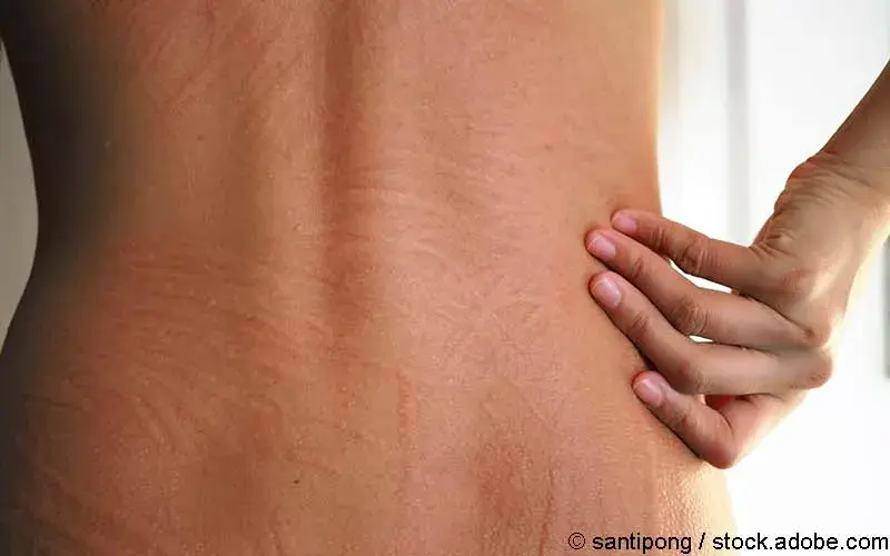 Urtikaria Nesselsucht