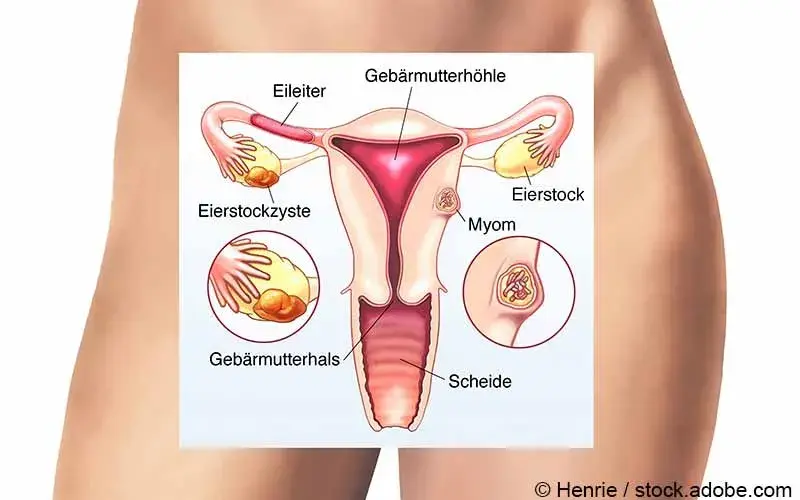 Uterusmyome