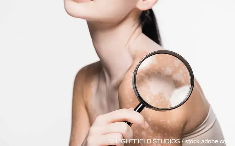 Vitiligo Lupe