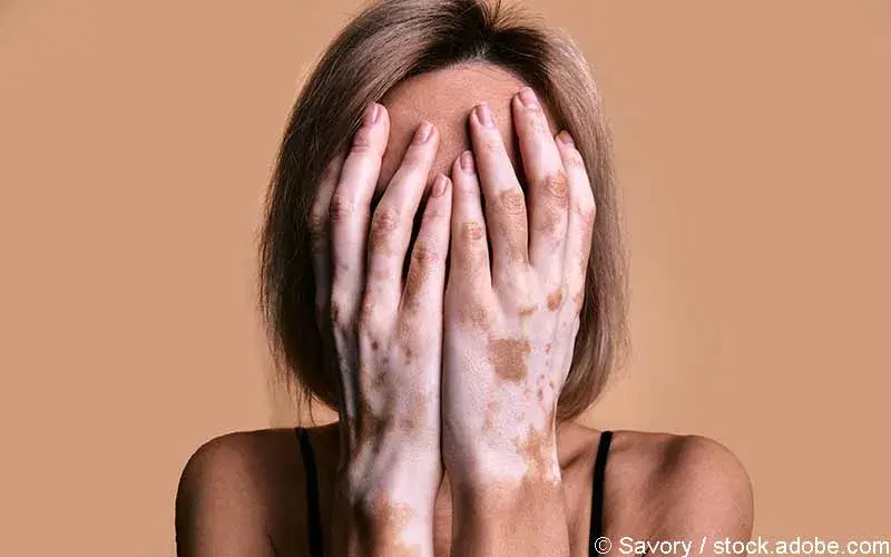 Vitiligo Weissfleckenkrankheit