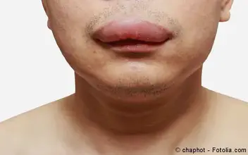 Angioödem Angioödem