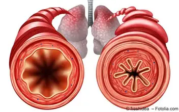Asthma bronchiale Asthma bronchiale