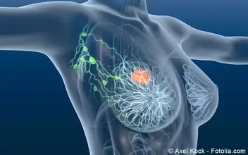 Brustkrebs Brustkrebs