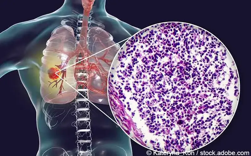 Kleinzelliges Lungenkarzinom